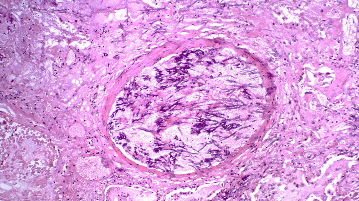 Aspergillosis,angioinvasive by Atlas of Pulmonary Pathology