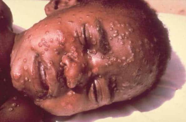 Young Boy With Face Lesions From Smallpox