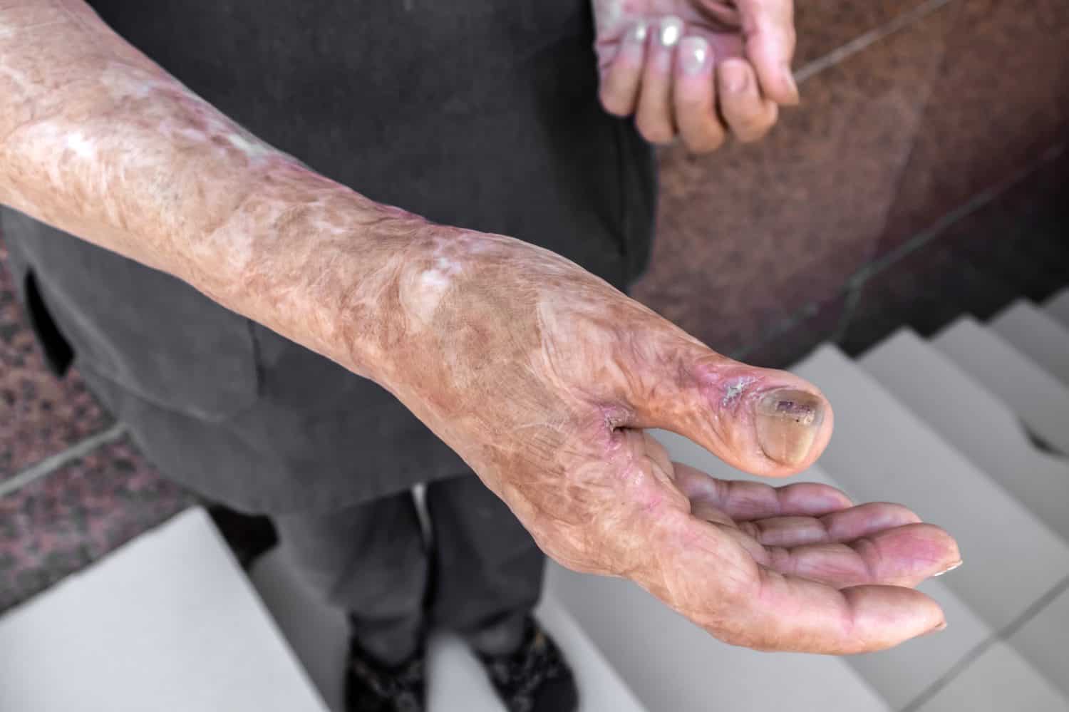 Scars after a burn on a woman&#039;s hand