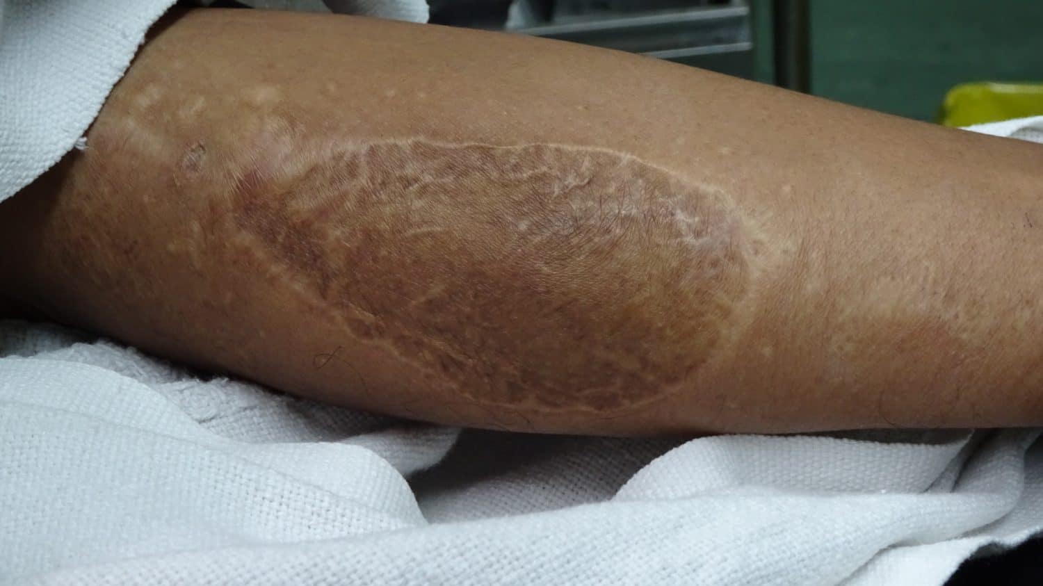 Old scar aroung the thigh due to previous harvesting of skin graft.