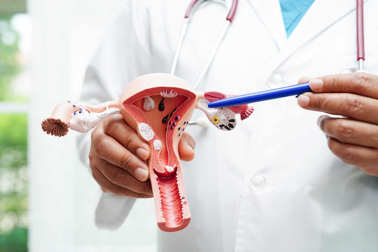 Uterus, doctor holding human anatomy model for study diagnosis and treatment in hospital.