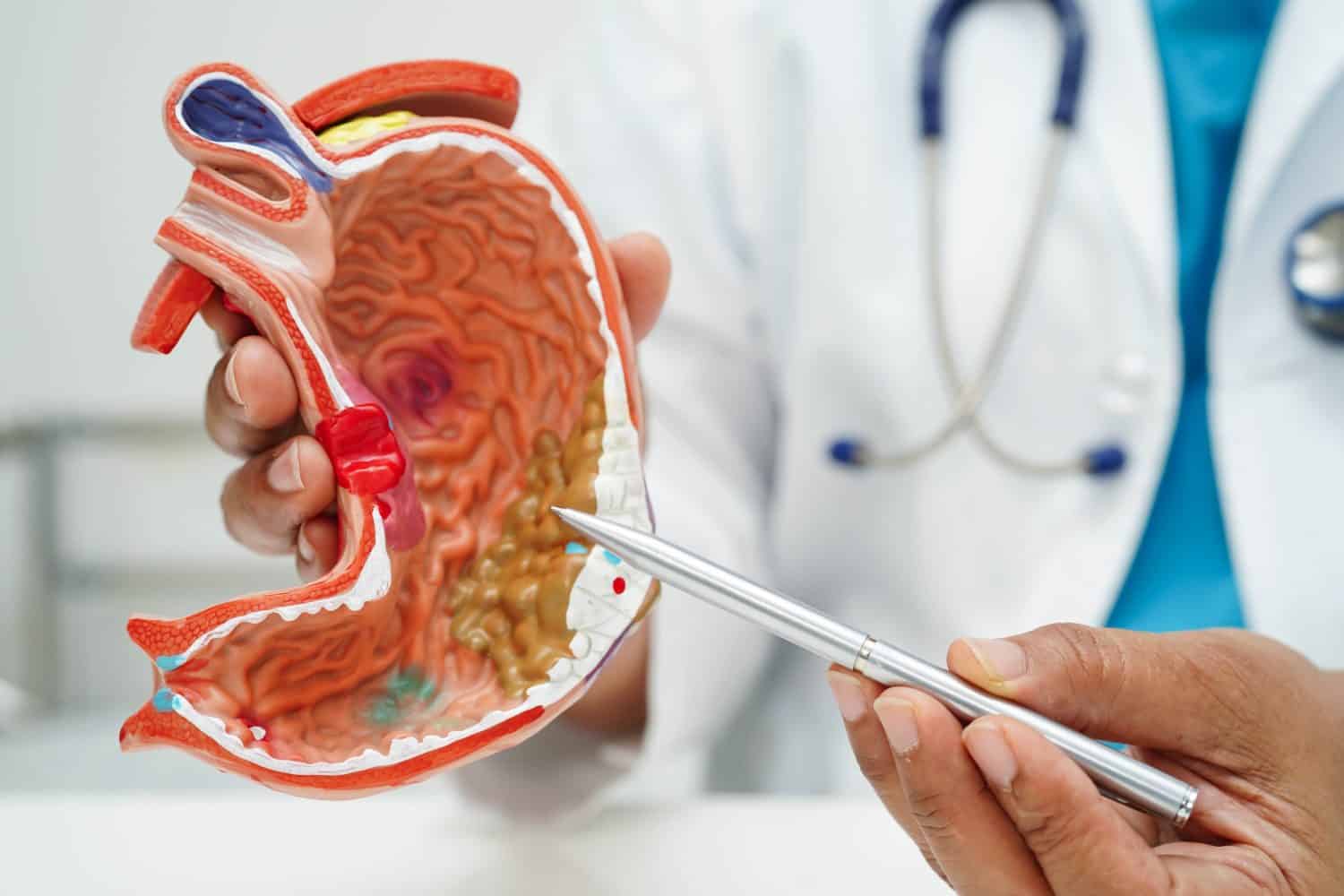 Stomach disease, doctor holding anatomy model for study diagnosis and treatment in hospital.